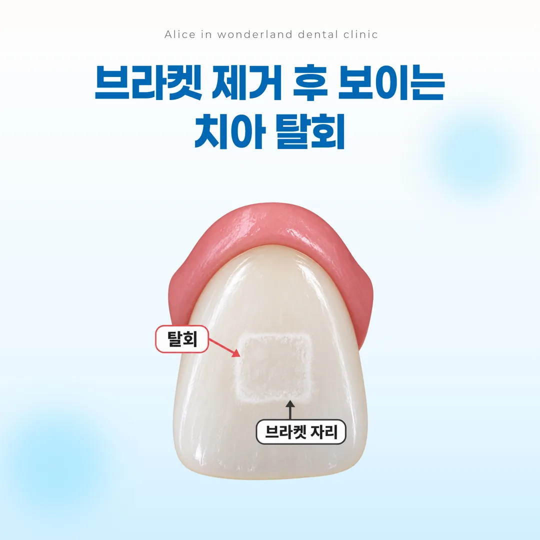 브라켓 둘레에 흰 자국으로 남는 탈회 부위를 표시한 도식