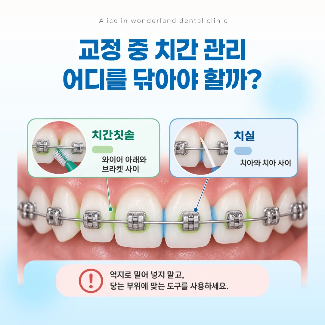 교정 장치를 낀 상태에서 교정용 칫솔과 치간칫솔, 치실이 닿는 부위를 표시한 도식