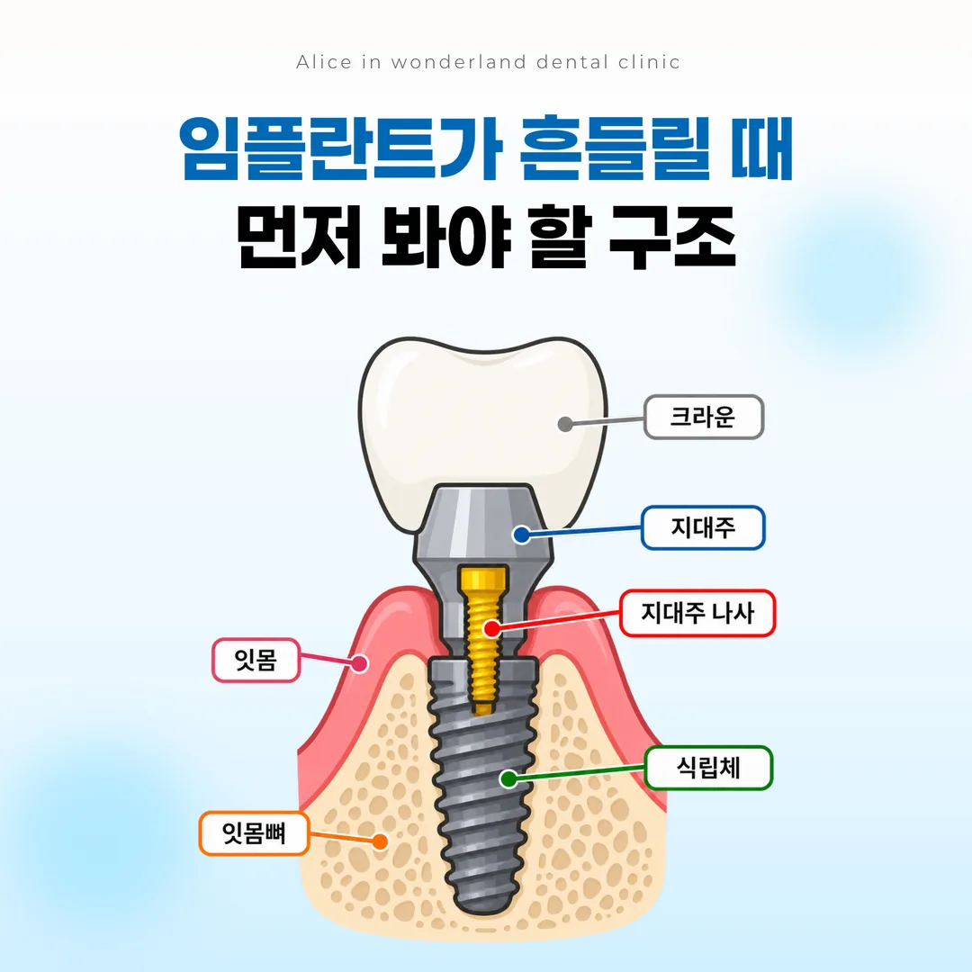 임플란트 식립체와 지대주, 지대주 나사, 크라운의 층 구조와 나사 위치를 표시한 단면 개념도