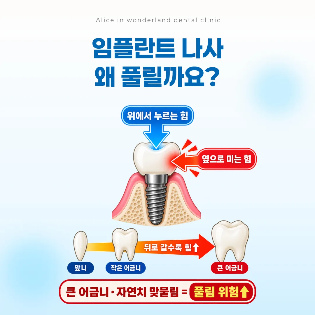 임플란트에 걸리는 수직력과 측방력의 방향, 어금니 쪽으로 갈수록 힘이 커지는 관계를 나타낸 개념도