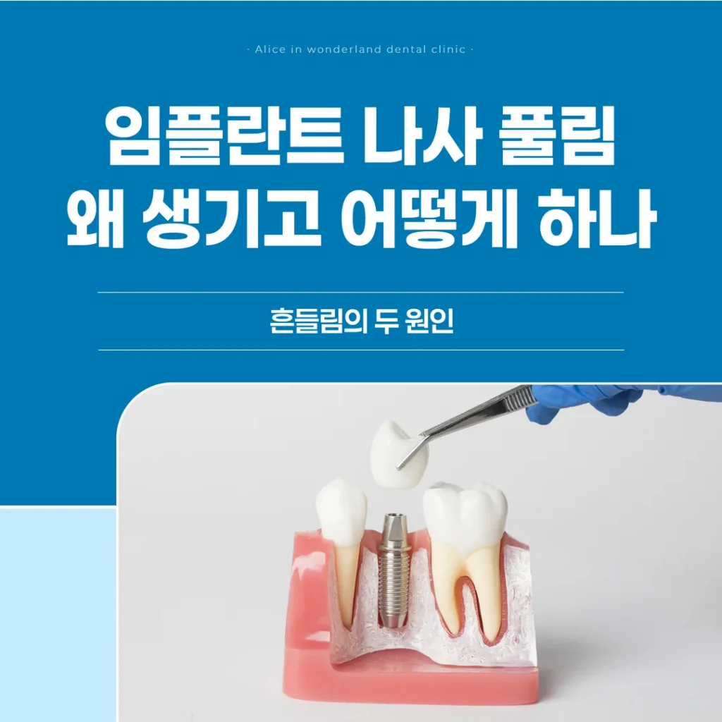 임플란트 나사 풀림, 왜 생기고 어떻게 하나 — 흔들림의 두 원인