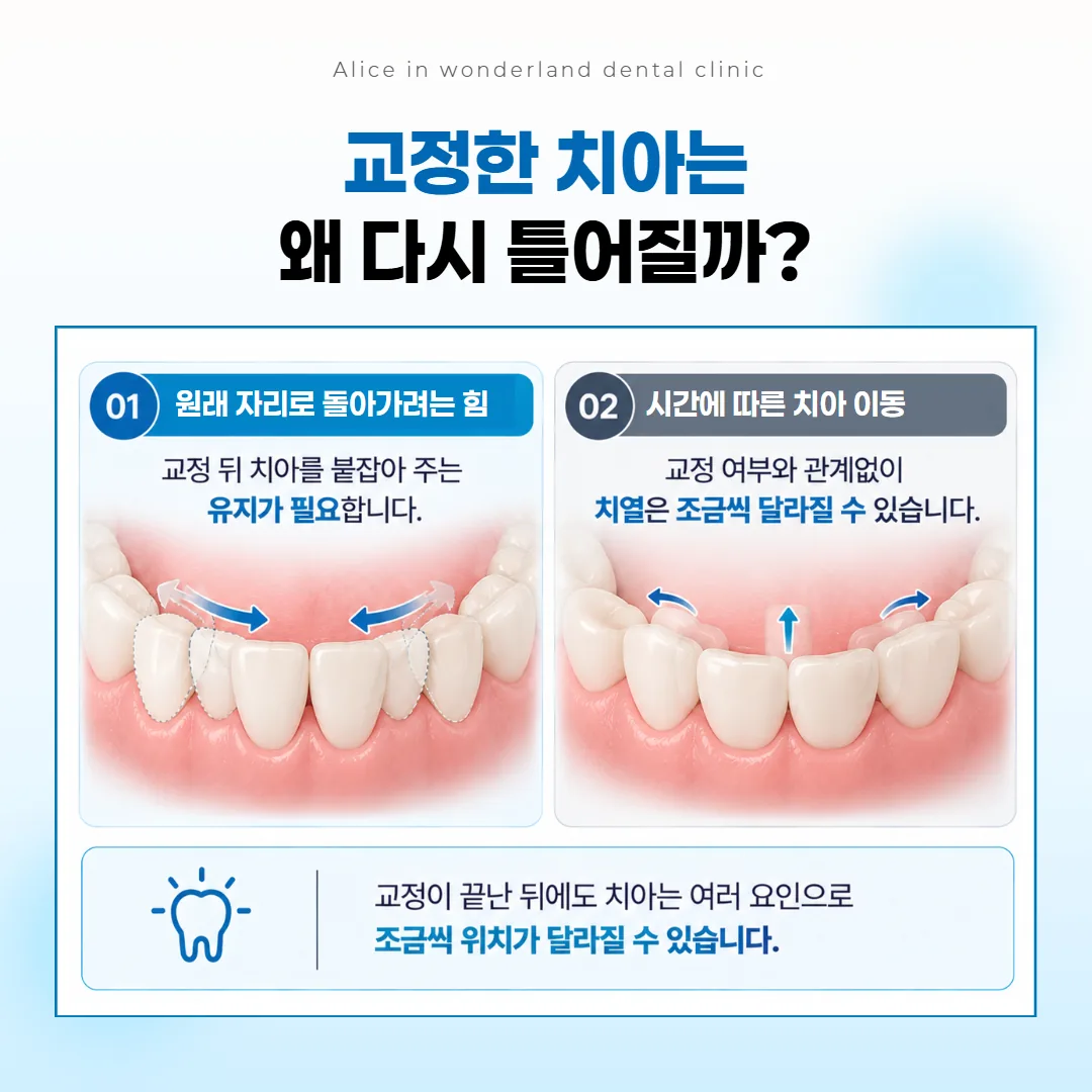 치아교정 재발이 생기는 두 가지 이유를 아래 앞니 그림으로 보여 주는 개념도