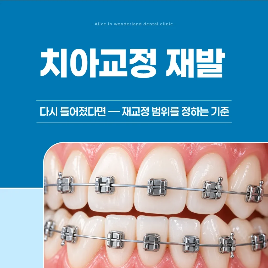 치아교정 재발, 다시 틀어졌다면 — 재교정 범위를 정하는 기준