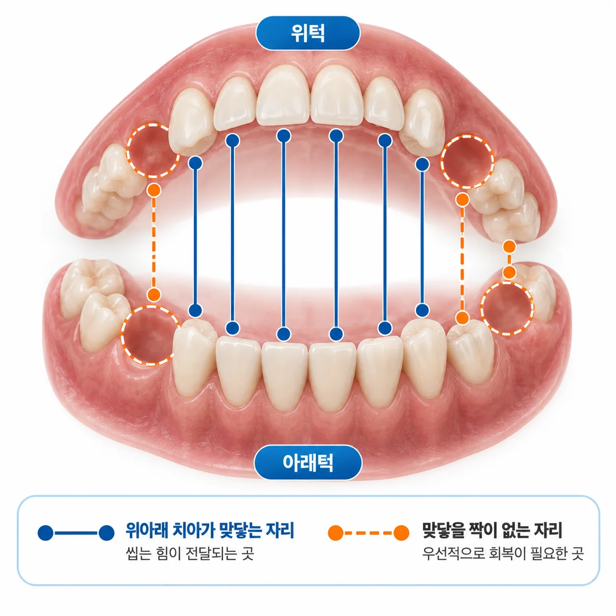 치아 여러 개가 빠진 위아래 치열에서 빈자리와 위아래가 맞닿는 자리를 선으로 표시한 그림