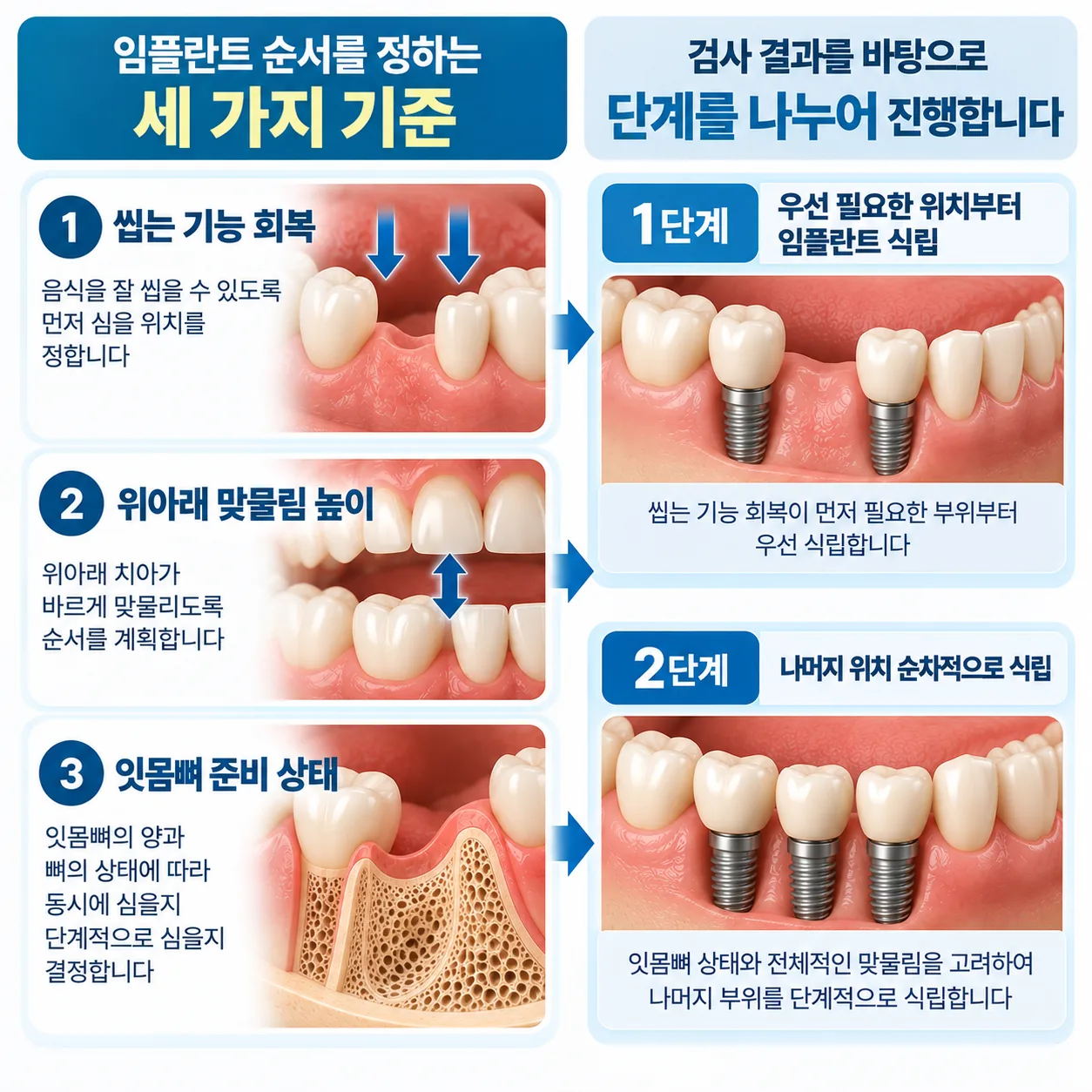 임플란트 순서를 정하는 세 가지 기준과 단계를 나누는 흐름 도식