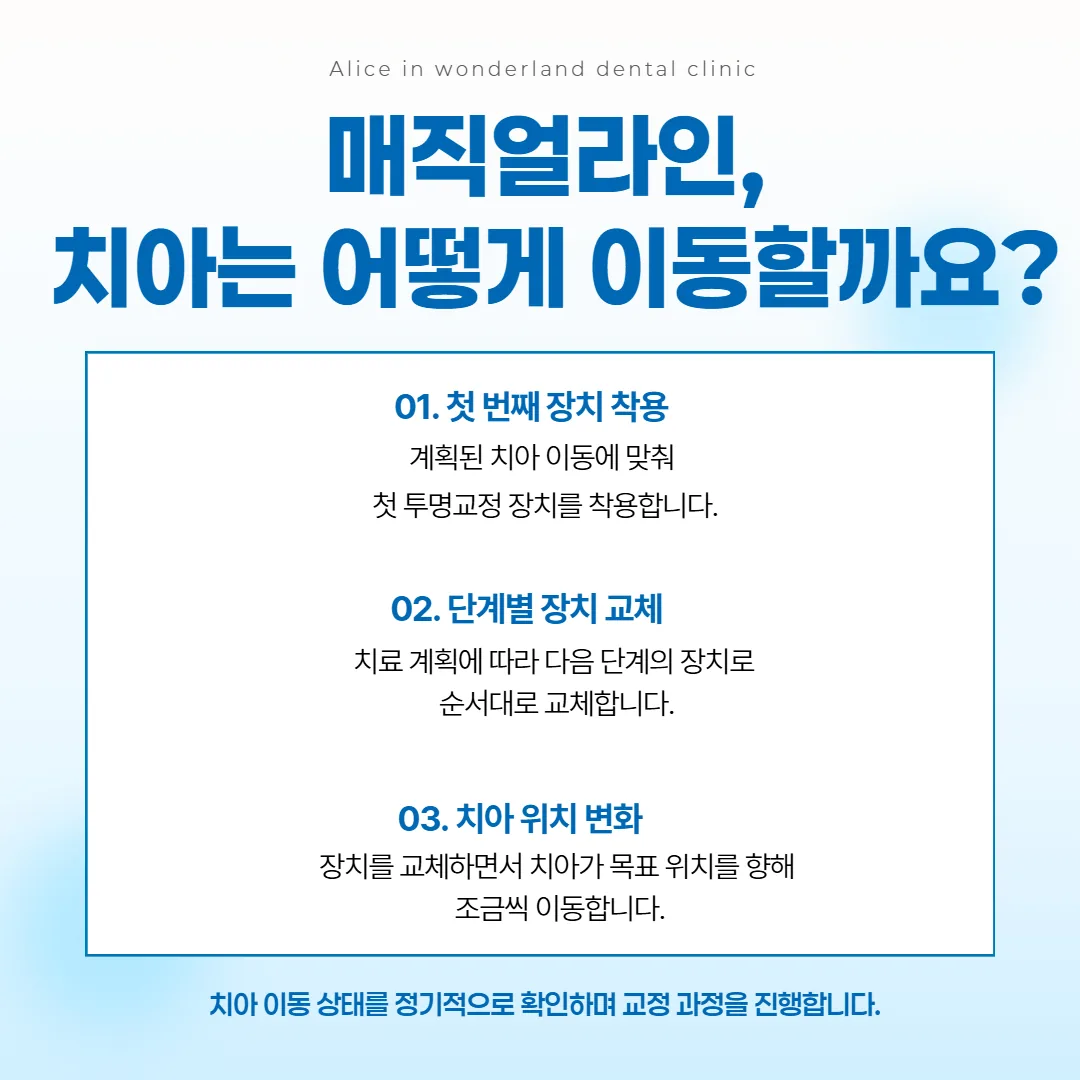단계별 투명 장치를 순서대로 바꿔 끼우며 치아가 조금씩 옮겨 가는 매직얼라인 진행 개념도