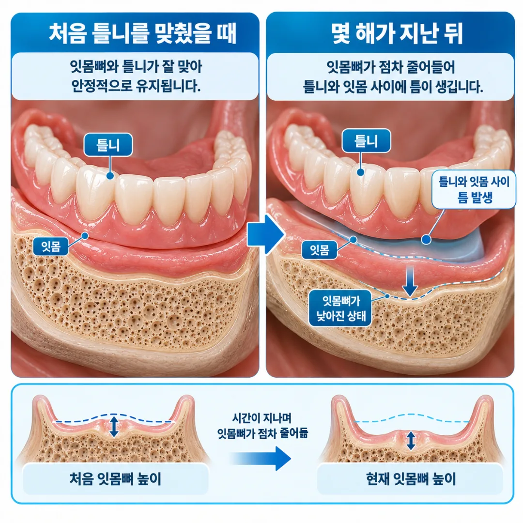잇몸뼈가 줄어들며 틀니와 잇몸 사이에 틈이 생기는 과정을 보여 주는 아래턱 단면 그림