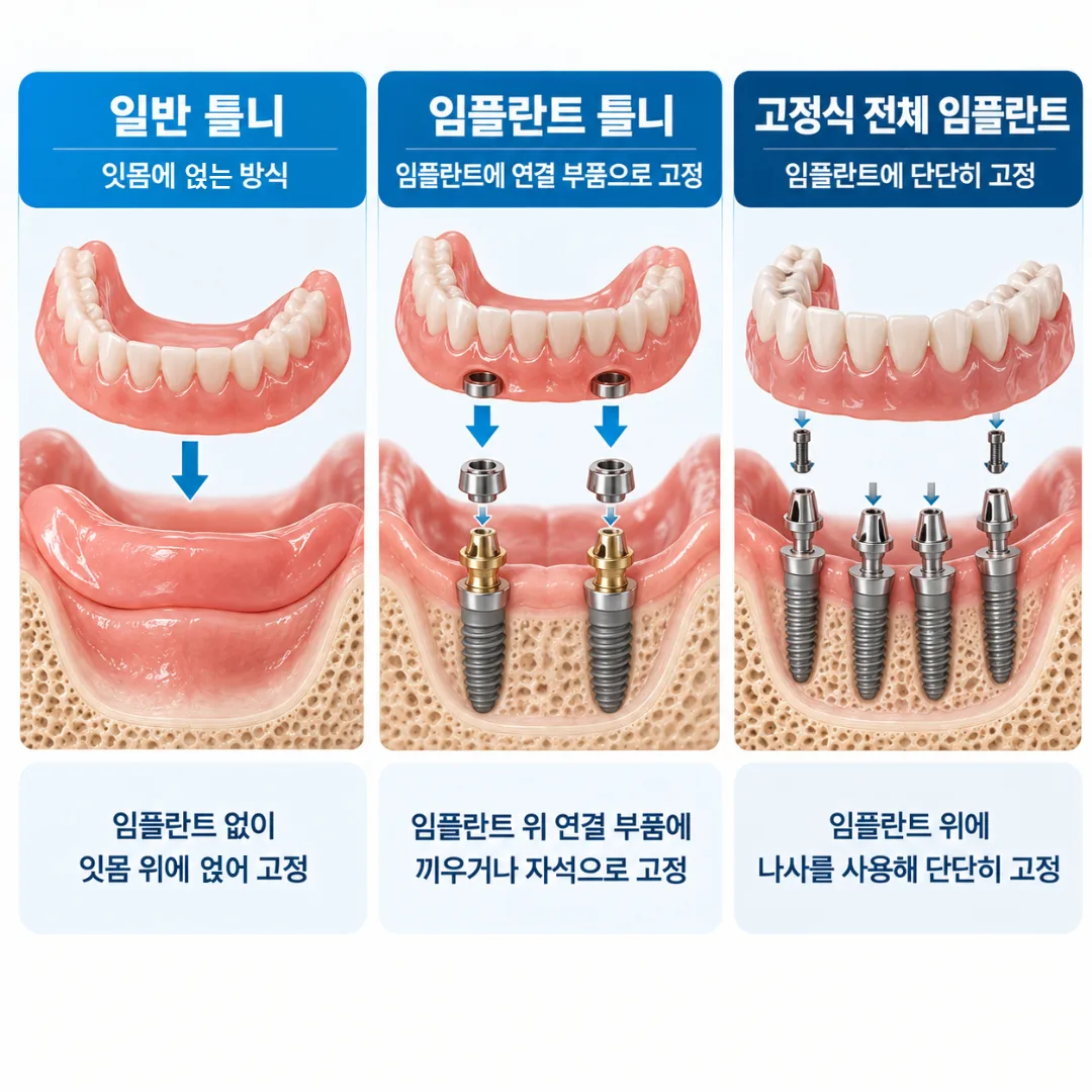 일반 틀니와 임플란트 틀니, 고정식 전체 임플란트가 고정되는 방식을 비교한 그림