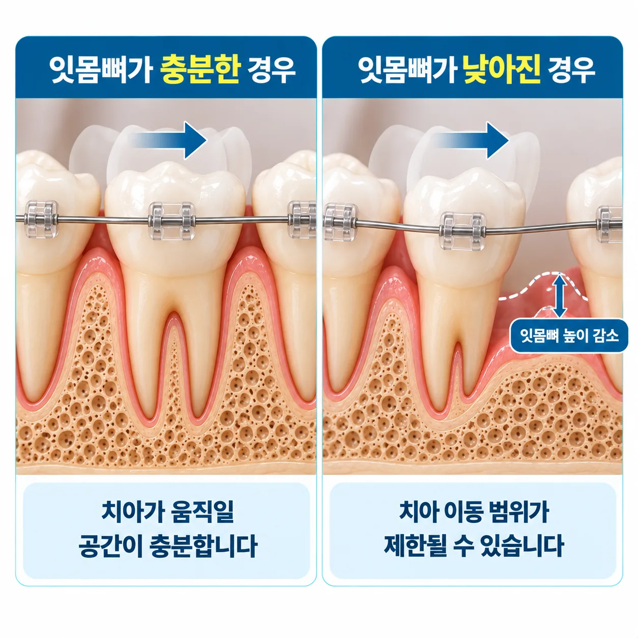 잇몸뼈 높이가 다른 두 치아 단면과 교정으로 치아가 움직이는 방향을 나타낸 그림