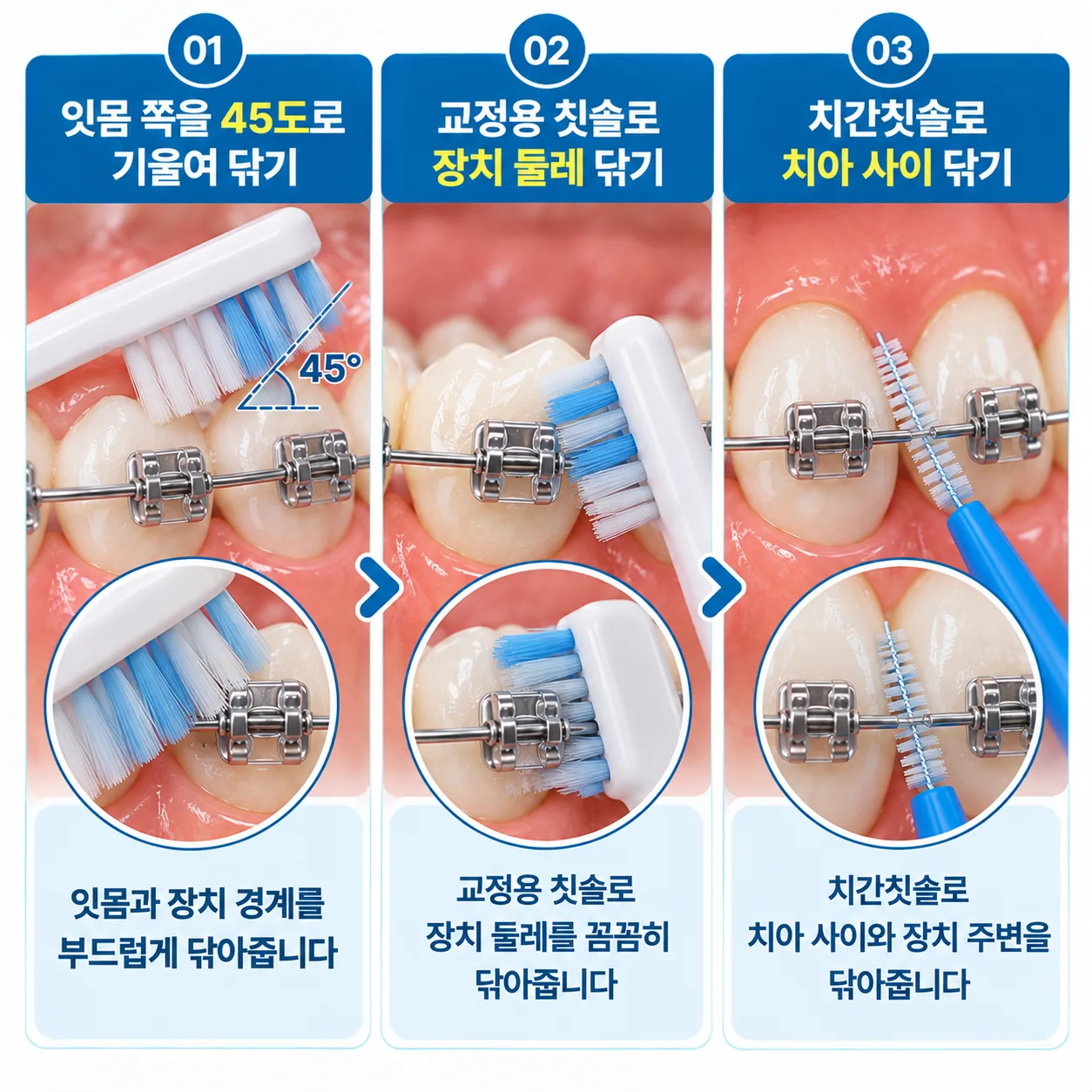 교정 장치를 붙인 치아의 잇몸 경계와 장치 둘레를 닦는 세 가지 방법 그림