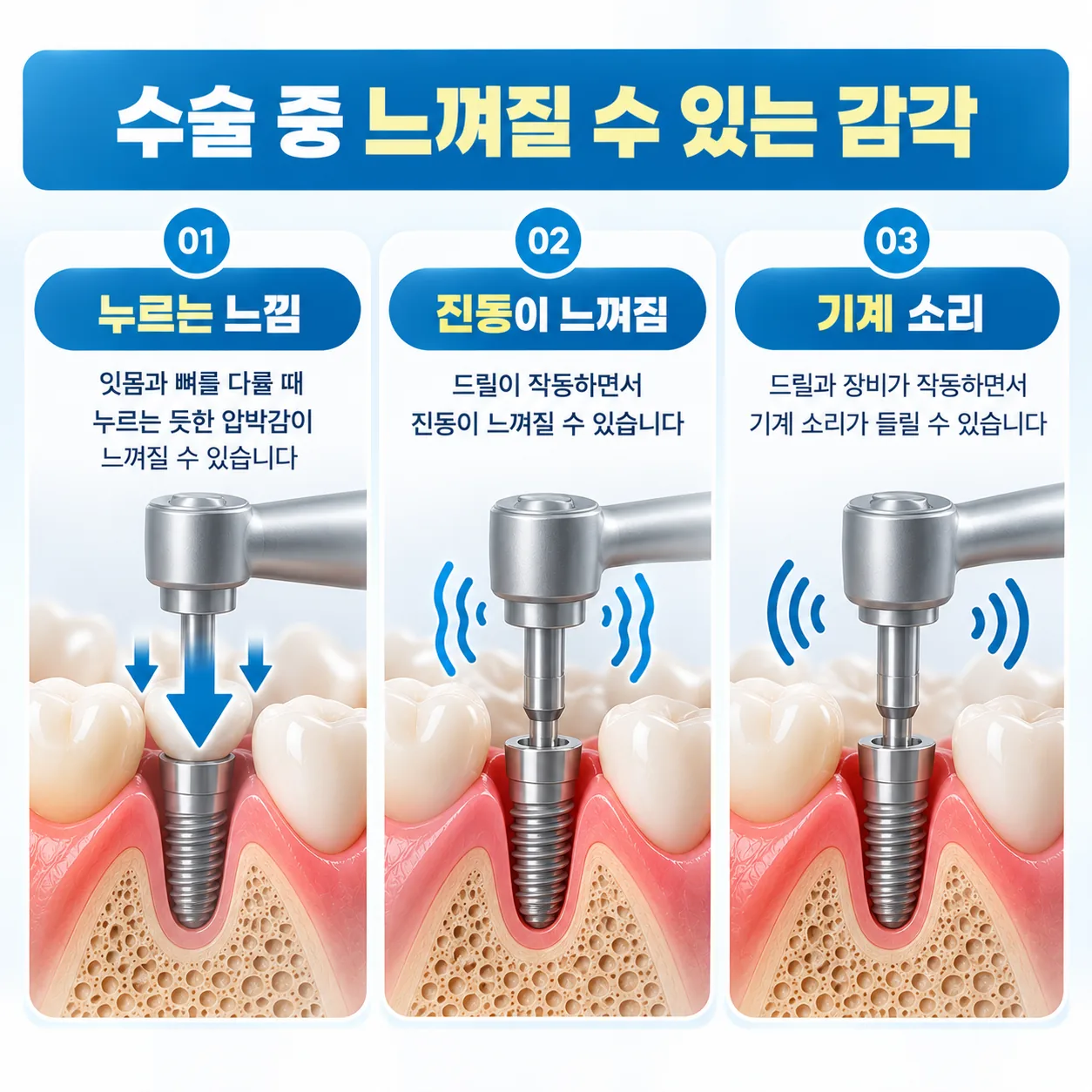 임플란트 수술 중 느껴질 수 있는 누르는 느낌과 진동, 소리를 나타낸 아이콘 그림