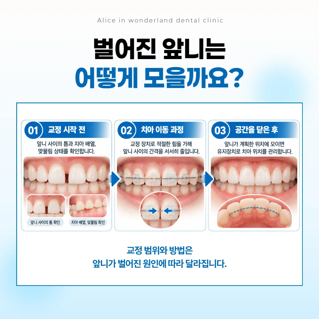 교정으로 앞니 틈을 천천히 모은 뒤 유지장치를 끼우는 순서 그림