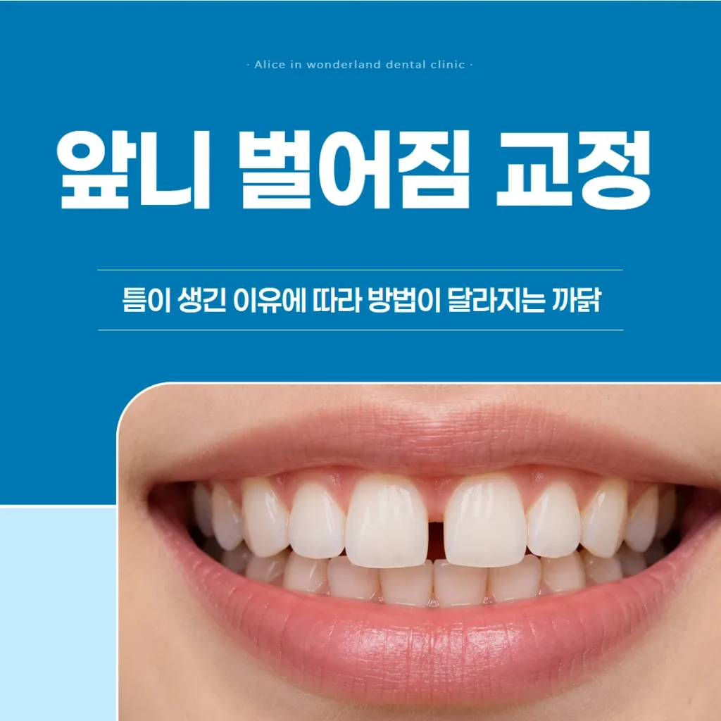 앞니 벌어짐 교정, 틈이 생긴 이유에 따라 방법이 달라지는 까닭