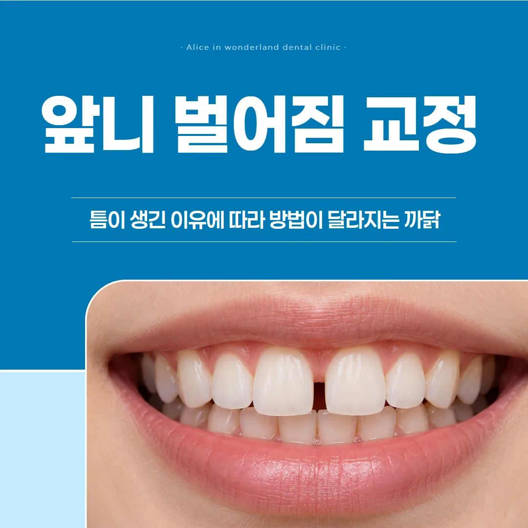앞니 벌어짐 교정, 틈이 생긴 이유에 따라 방법이 달라지는 까닭