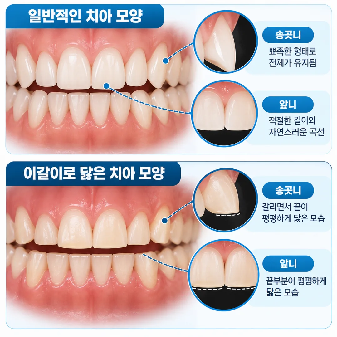 이갈이로 송곳니와 앞니 끝이 평평하게 닳은 치아 모양 그림
