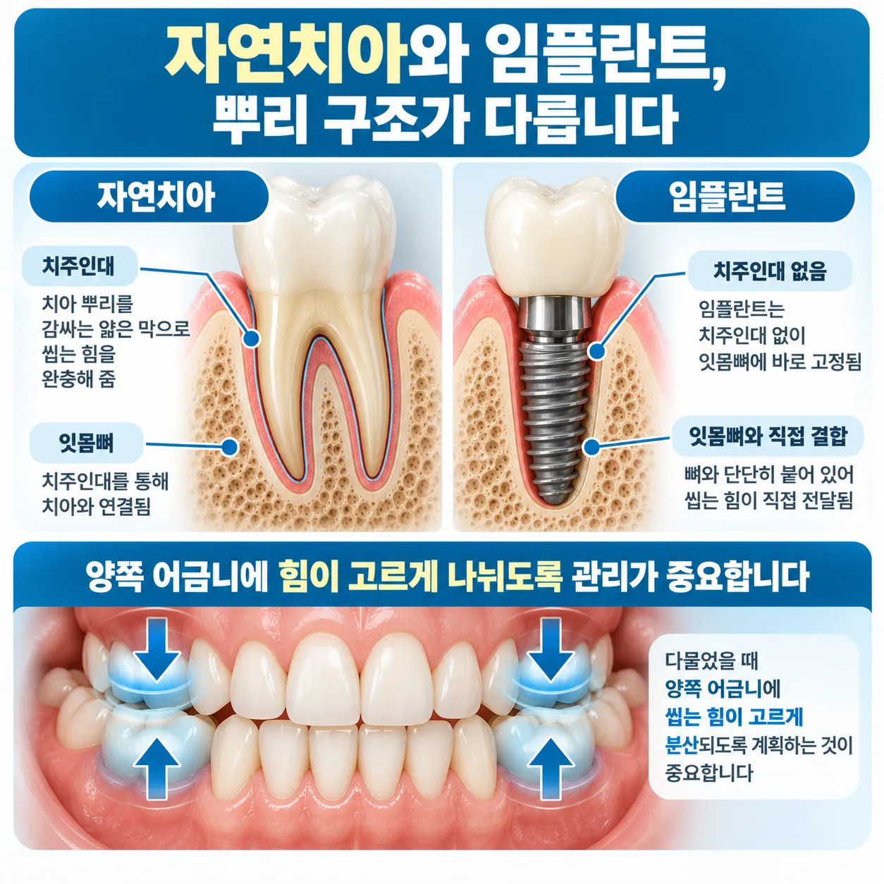 자연치아와 임플란트의 뿌리 구조와 양쪽 어금니에 고르게 나뉘는 씹는 힘 개념도