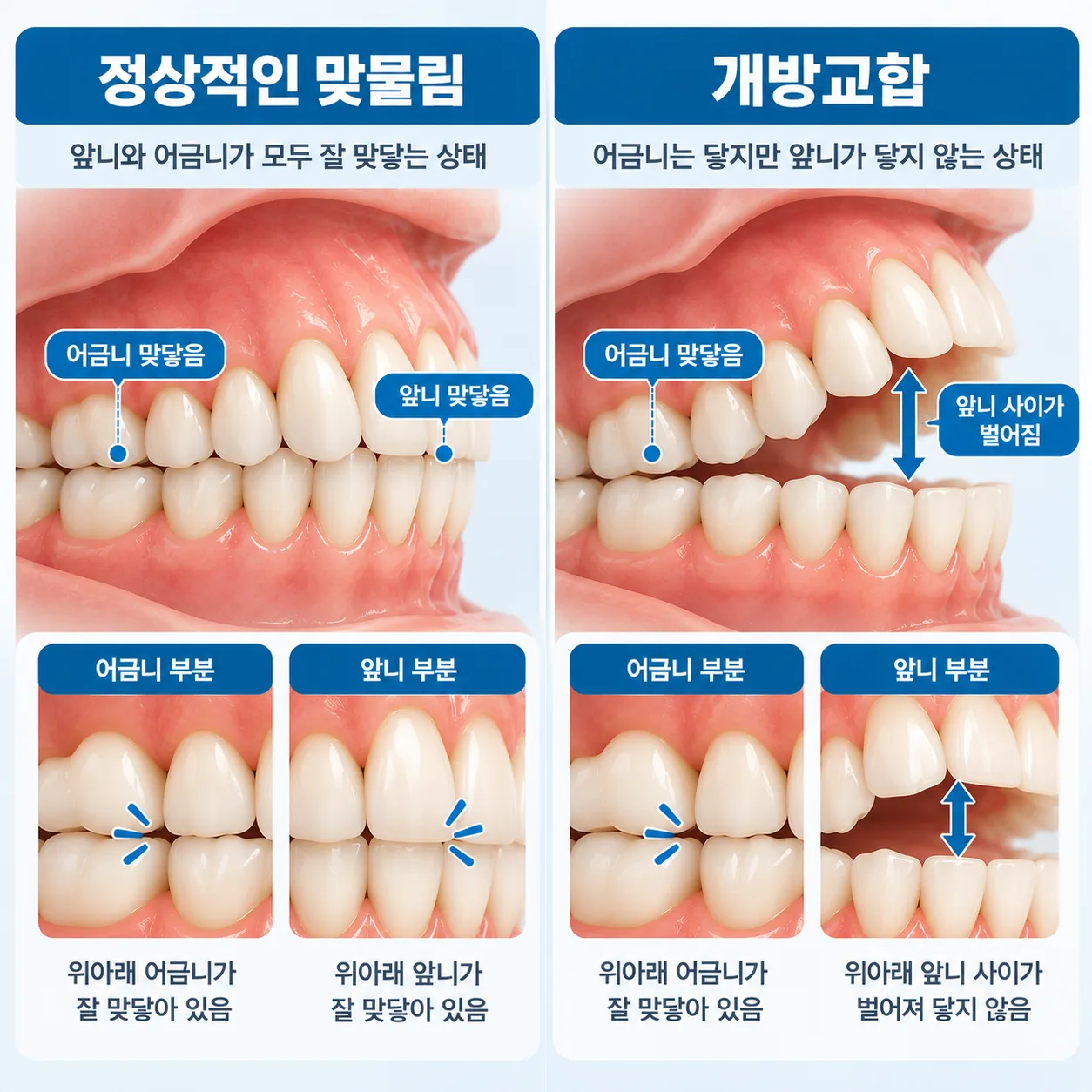 어금니는 닿고 앞니만 닿지 않는 개방교합 맞물림을 보통 맞물림과 비교한 선 그림