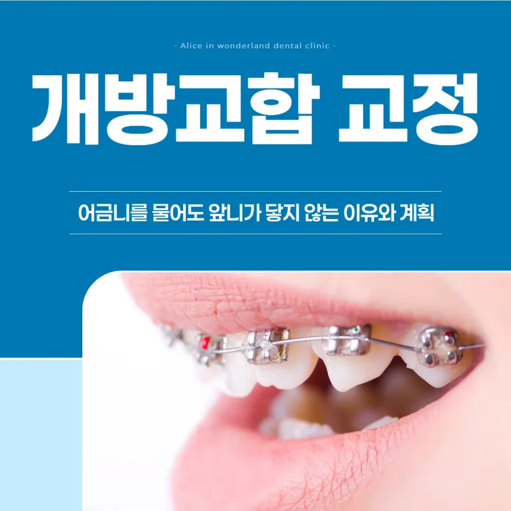 개방교합 교정, 어금니를 물어도 앞니가 닿지 않는 이유와 계획