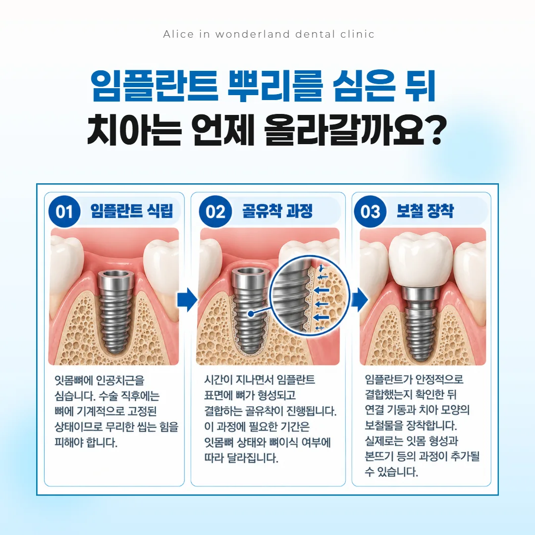 임플란트 뿌리를 심은 날부터 뼈와 붙는 기간을 거쳐 보철을 올리기까지의 흐름 도식