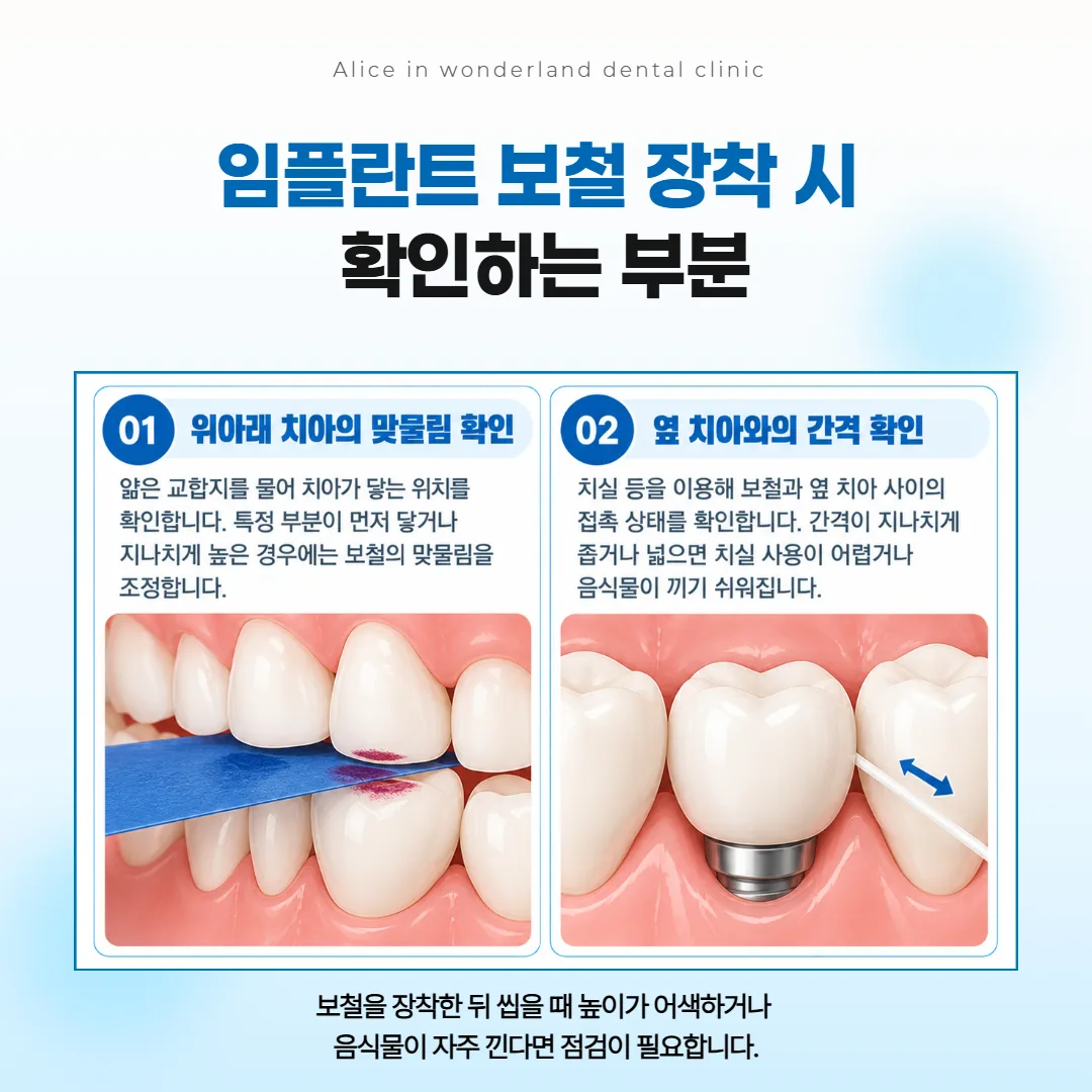 임플란트 보철을 올리는 날 맞물림 높이와 옆 치아 사이를 살피는 두 가지 그림