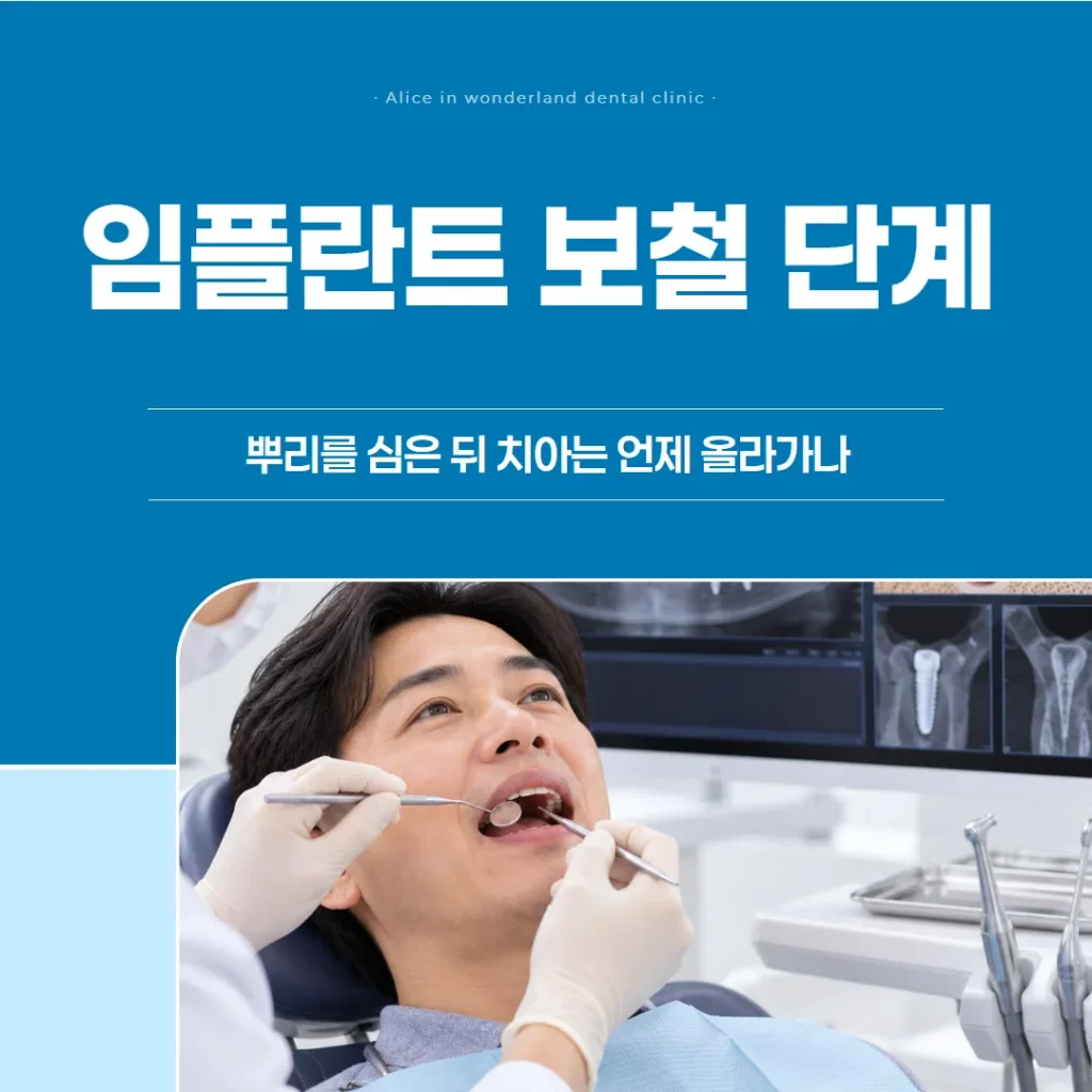 임플란트 보철 단계, 뿌리를 심은 뒤 치아는 언제 올라가나