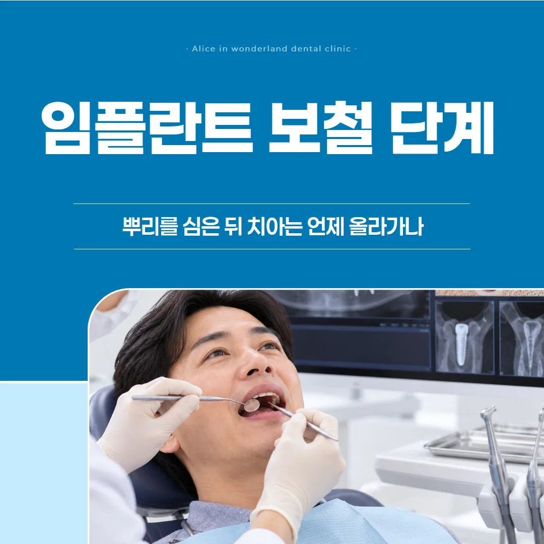 임플란트 보철 단계, 뿌리를 심은 뒤 치아는 언제 올라가나