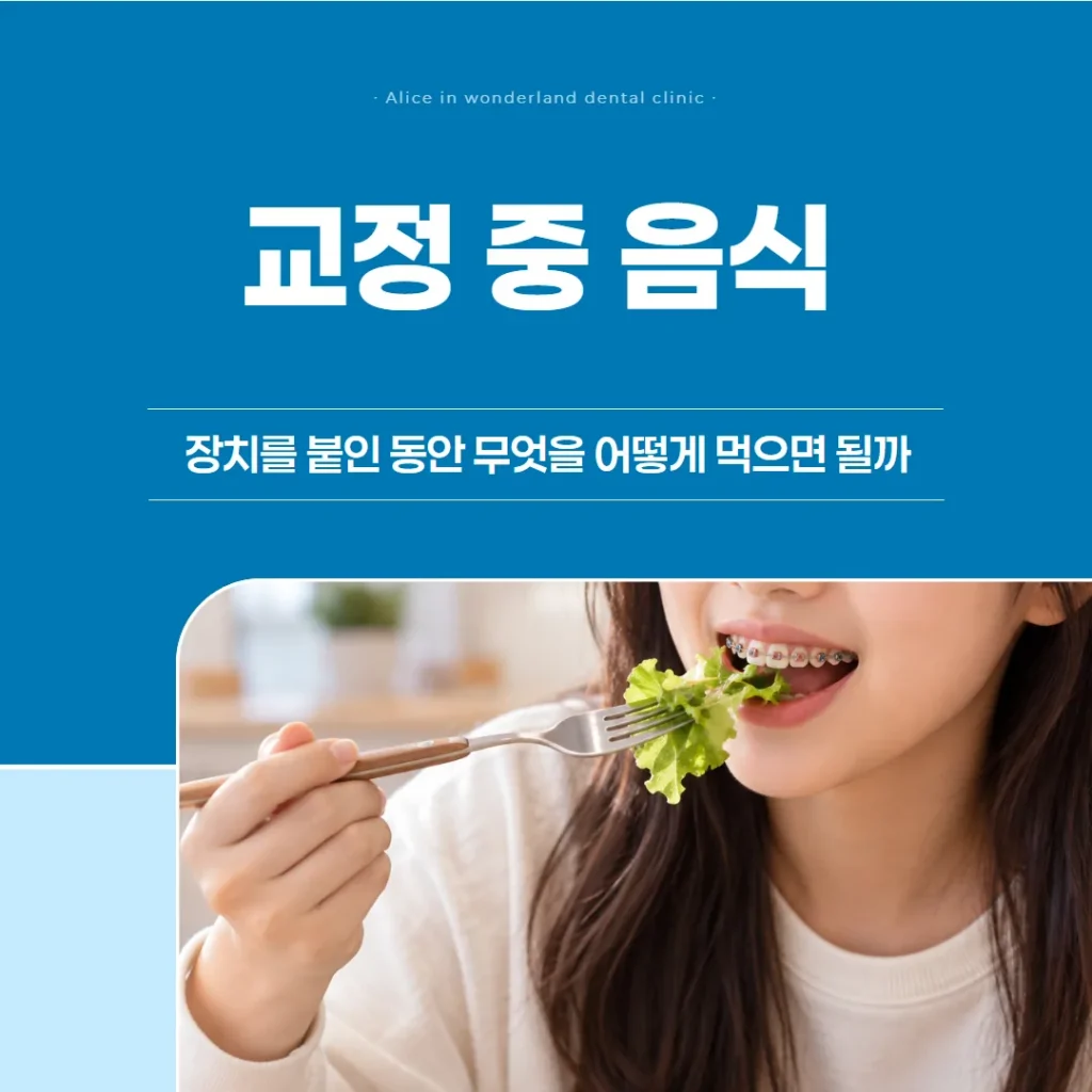 교정 중 음식, 장치를 붙인 동안 무엇을 어떻게 먹으면 될까