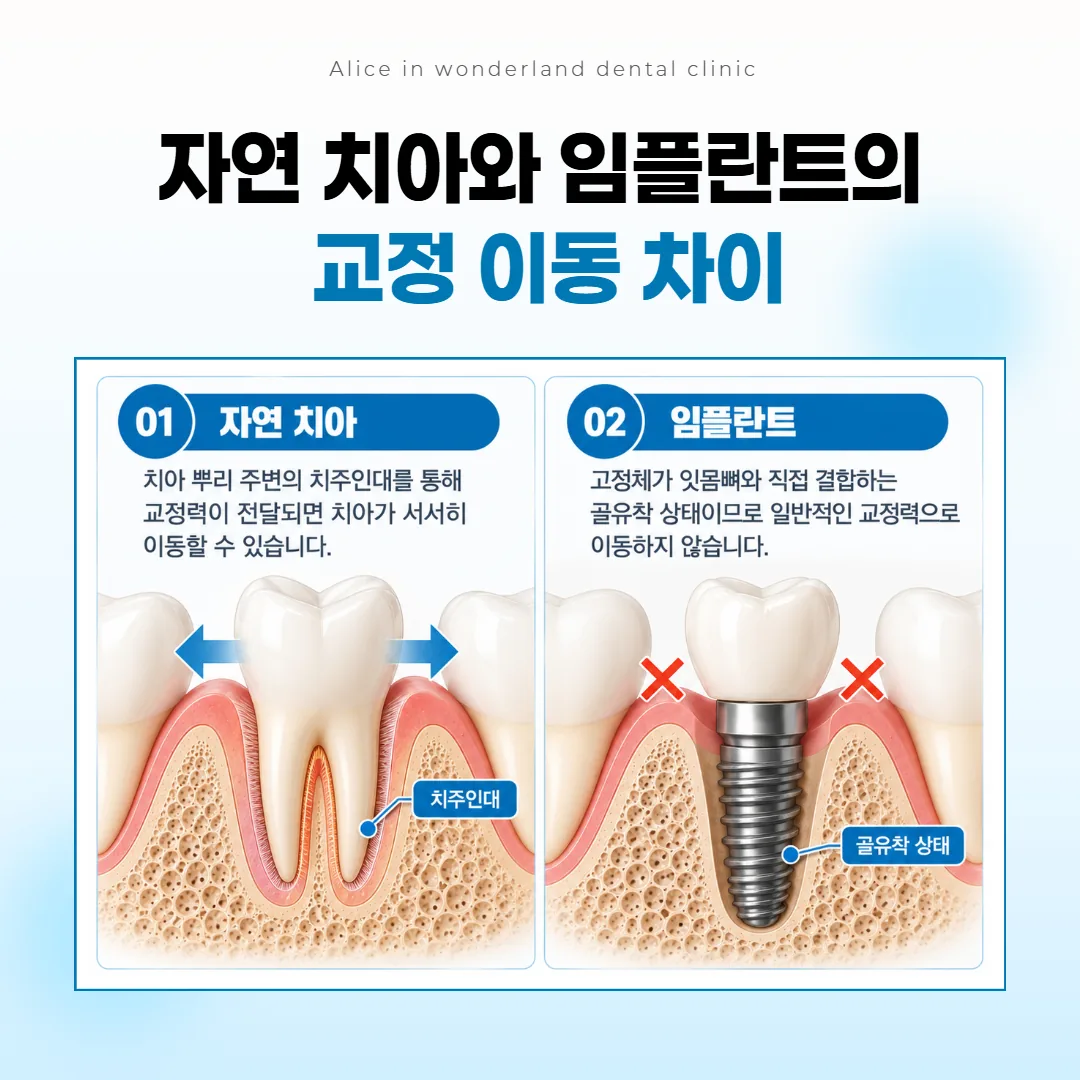 교정 힘으로 움직이는 자연 치아와 잇몸뼈에 붙어 자리를 지키는 임플란트를 좌우에 그린 단면 그림
