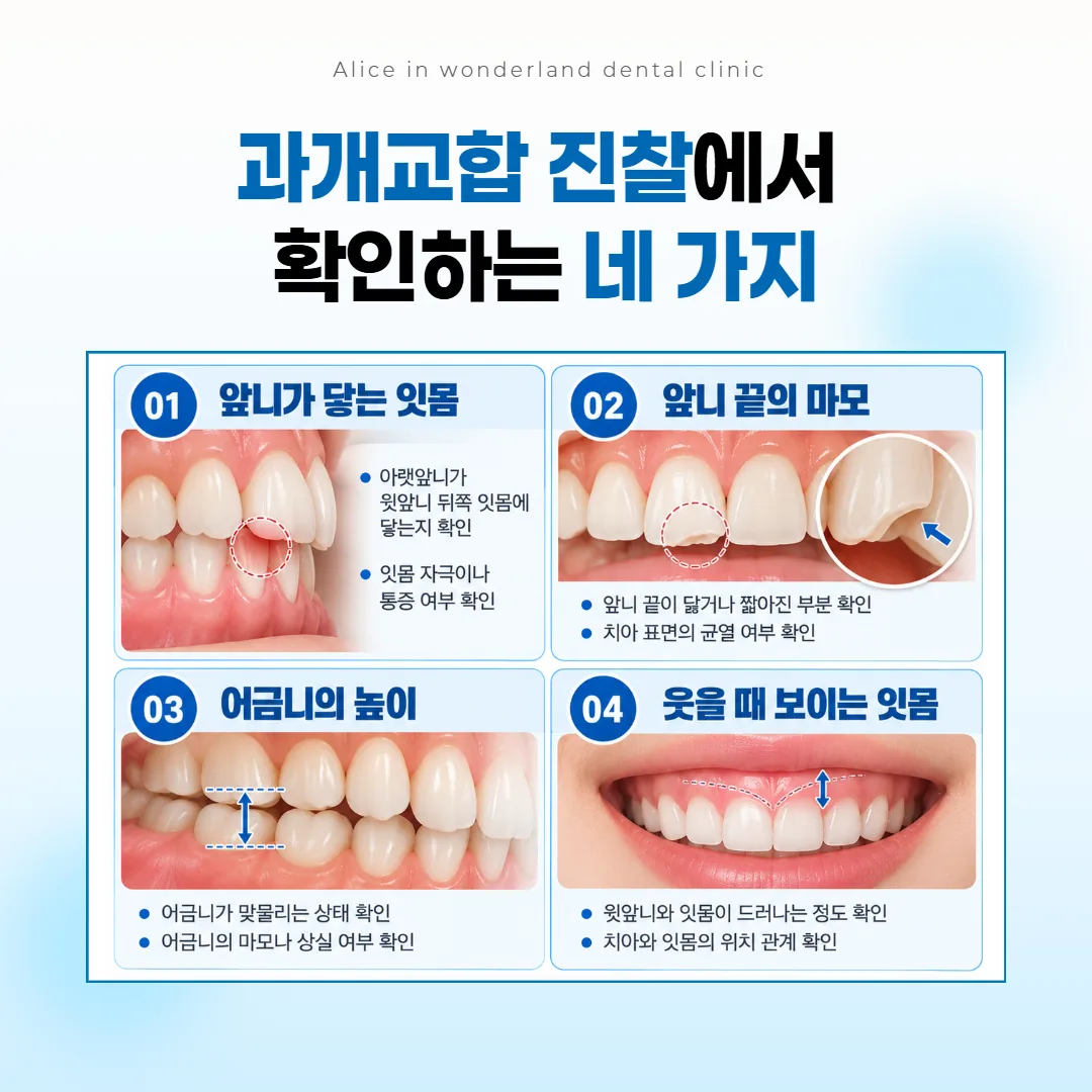 과개교합 진찰에서 잇몸 닿음과 앞니 끝, 어금니 높이, 웃을 때 잇몸을 살피는 순서 그림