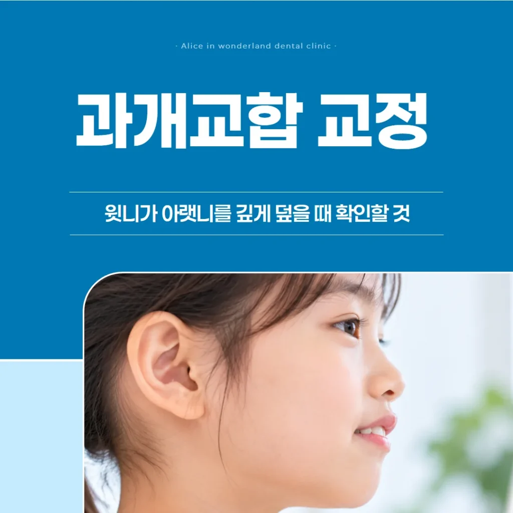 과개교합 교정, 윗니가 아랫니를 깊게 덮을 때 확인할 것