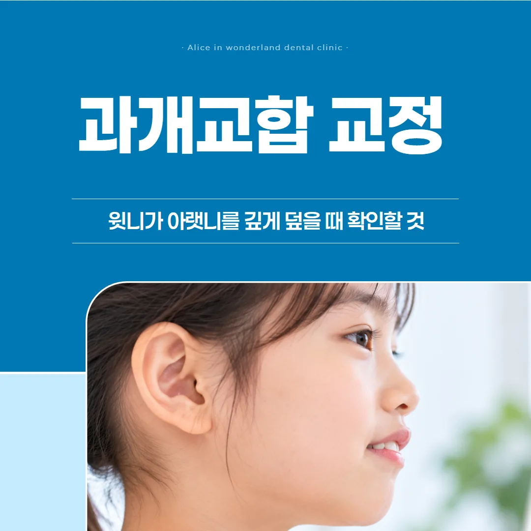 과개교합 교정, 윗니가 아랫니를 깊게 덮을 때 확인할 것