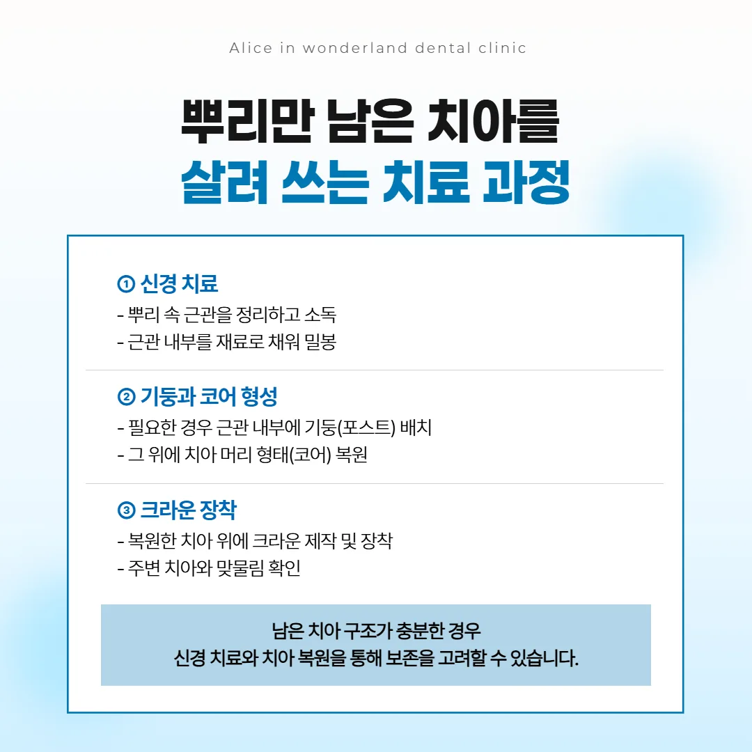 뿌리만 남은 치아를 신경 치료와 기둥, 크라운 순서로 살려 쓰는 과정을 세 칸으로 그린 단면 그림