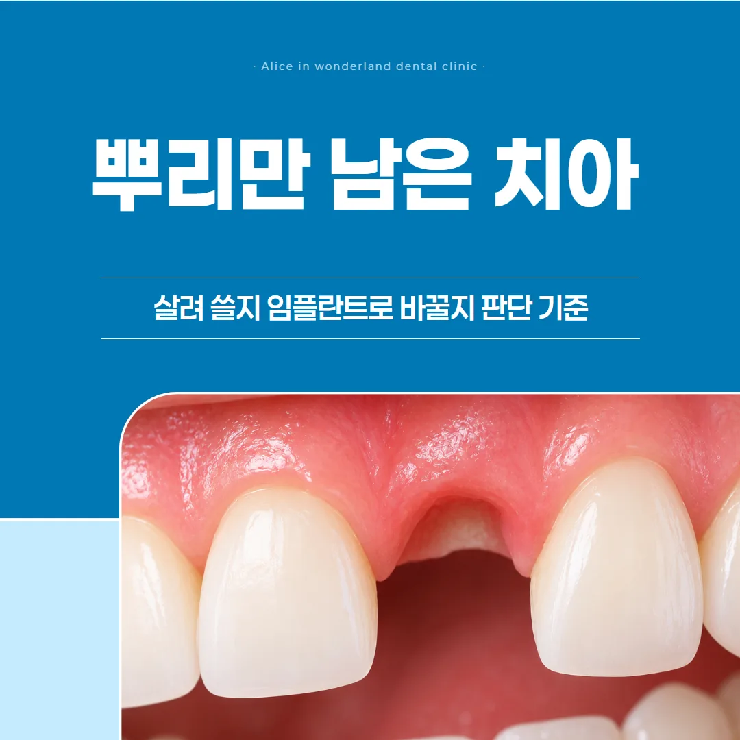 뿌리만 남은 치아, 살려 쓸지 임플란트로 바꿀지 판단 기준