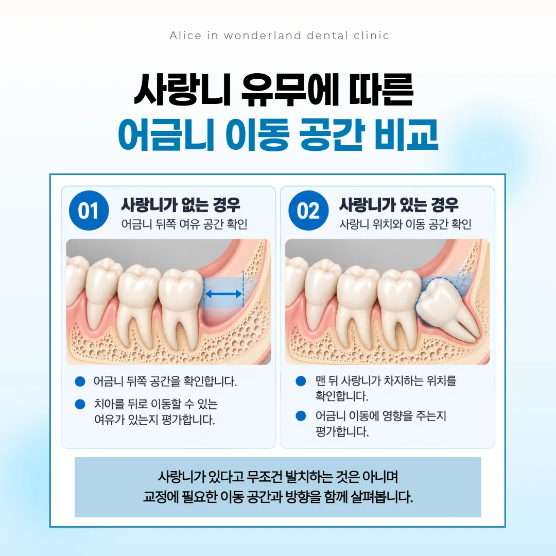 어금니를 뒤로 옮기는 교정 계획에서 맨 뒤 사랑니가 있을 때와 없을 때의 여유 공간을 두 칸으로 견준 그림