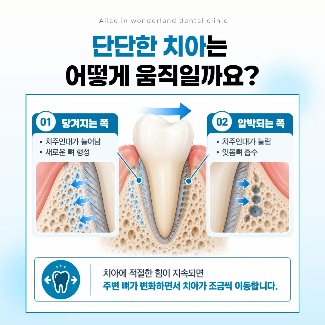 치아를 미는 쪽 뼈는 줄고 반대쪽에는 새 뼈가 채워지며 치아가 옮겨 가는 원리를 그린 단면 그림