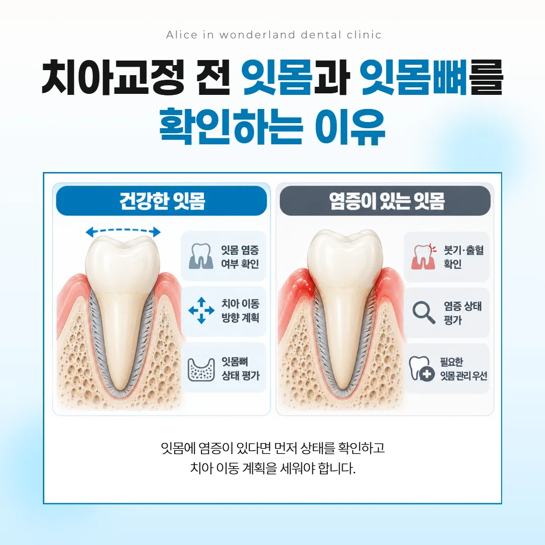 잇몸과 뼈가 건강한 상태에서 치아가 옮겨 갈 방향을 표시한 단면 비교 그림