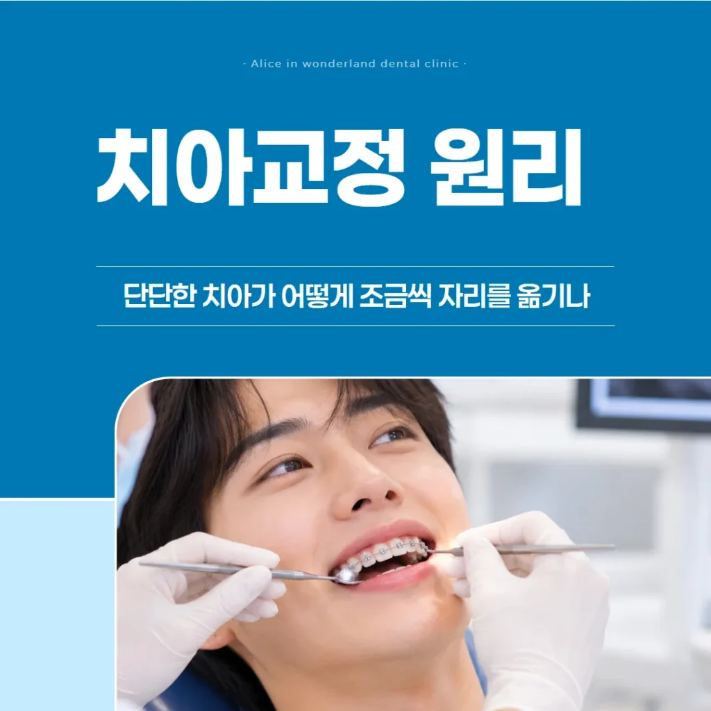 치아교정 원리, 단단한 치아가 어떻게 조금씩 자리를 옮기나