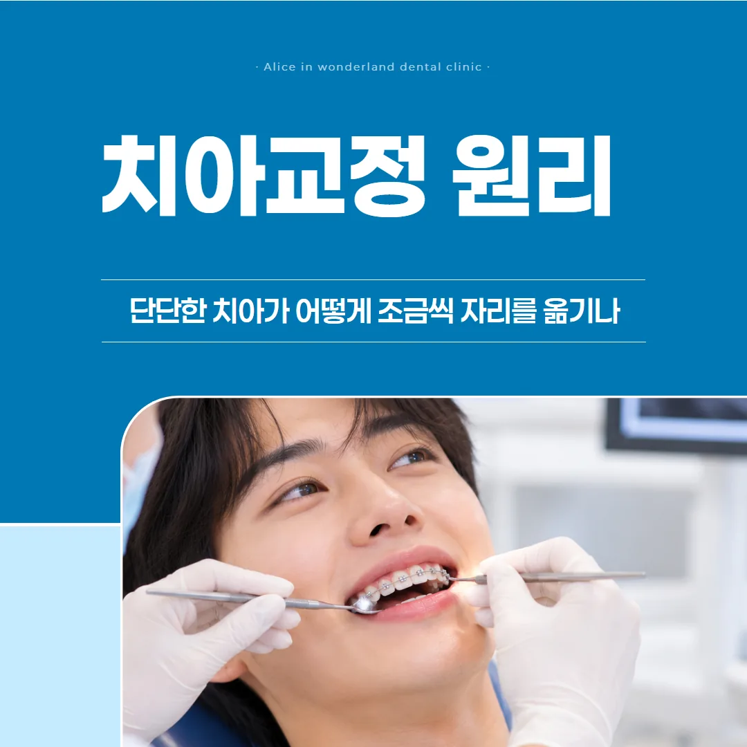 치아교정 원리, 단단한 치아가 어떻게 조금씩 자리를 옮기나